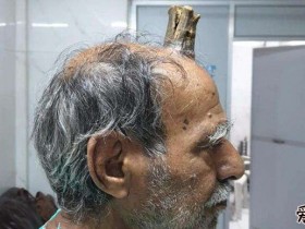 印度男子头部长出牛角, 这是怎么回事如今怎样了
